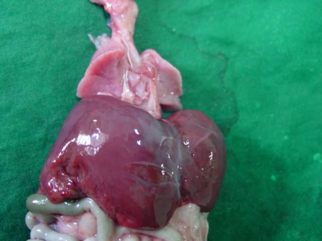 Akinesia Fetal.Hipoplasia Pulmonar - A-05-53. Akinesia Fetal. Hipoplasia Pulmonar